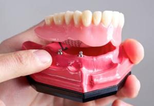 How Denture And Implant Dentistry Restores Natural Looking Smiles